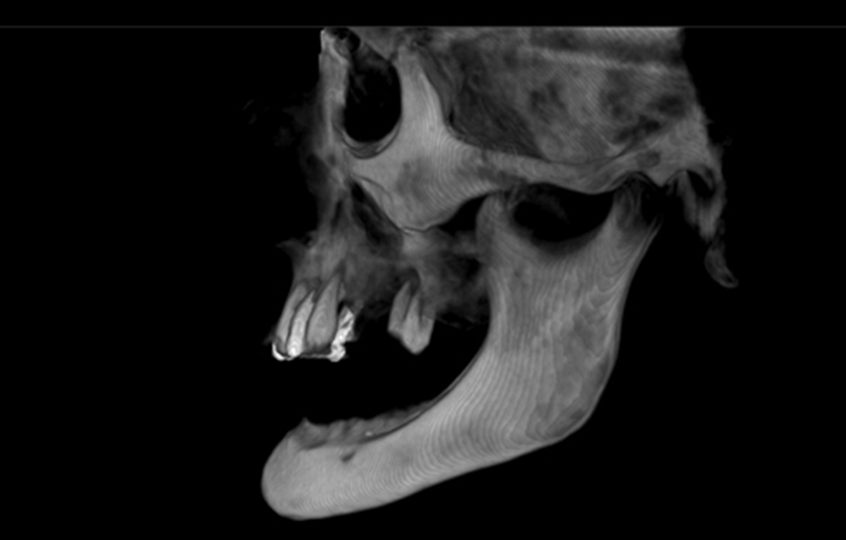 Pro tohoto pacienta byly naplánovány fixní náhrady v obou obloucích nesené implantáty. Po extrakci zbylých zubů v horním oblouku následovalo okamžité zavedení a zatížení implantátů v obou obloucích.