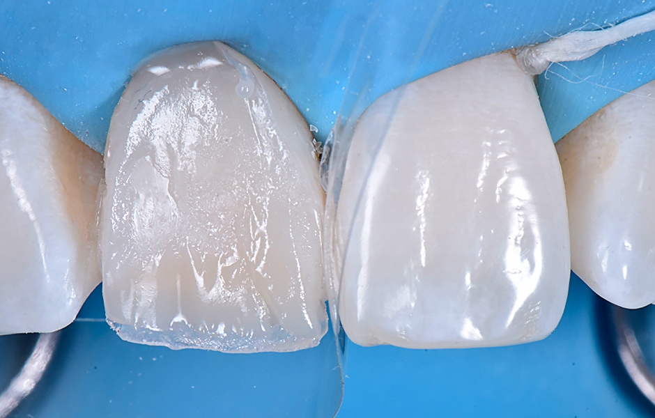 Obr. 9: Rekonstrukce anatomie dentinu opakním kompozitem odstínu dentinu.