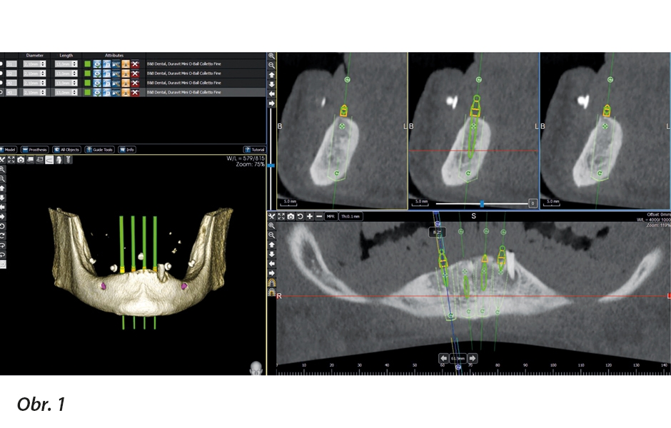 Trojrozměrné virtuální plánování pozic implantátů