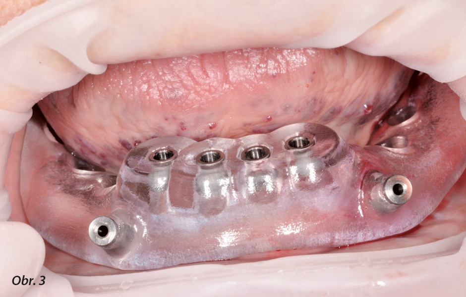 Implantační šablona s vrtacími otvory pro preparaci implantačních lůžek a s labiálními štolami pro kotevní šrouby