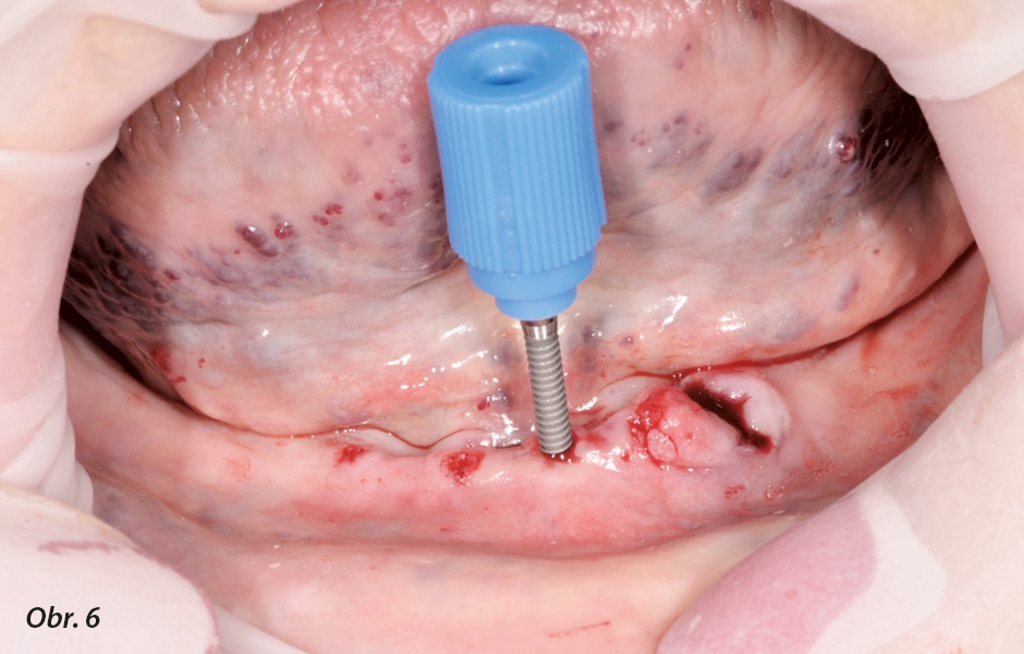 Umístění implantátů a mírné zašroubování pomocí přenosového klíče