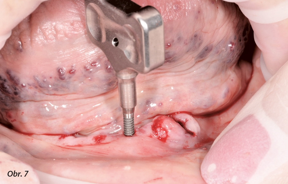 Zavedení implantátu křidélkovým nástrčným klíčem