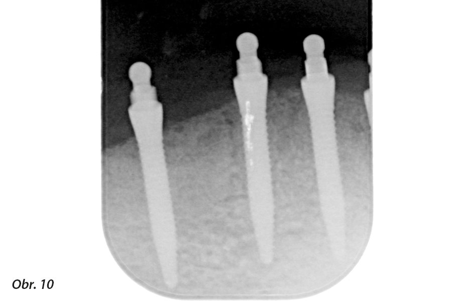 Kontrolní rentgenový snímek zavedených implantátů