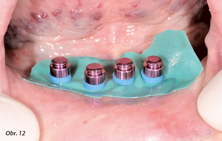 Implantáty v ústech pacientky s nasazeným kofferdamem, kovová pouzdra a blokační trubičky v podsekřivinách