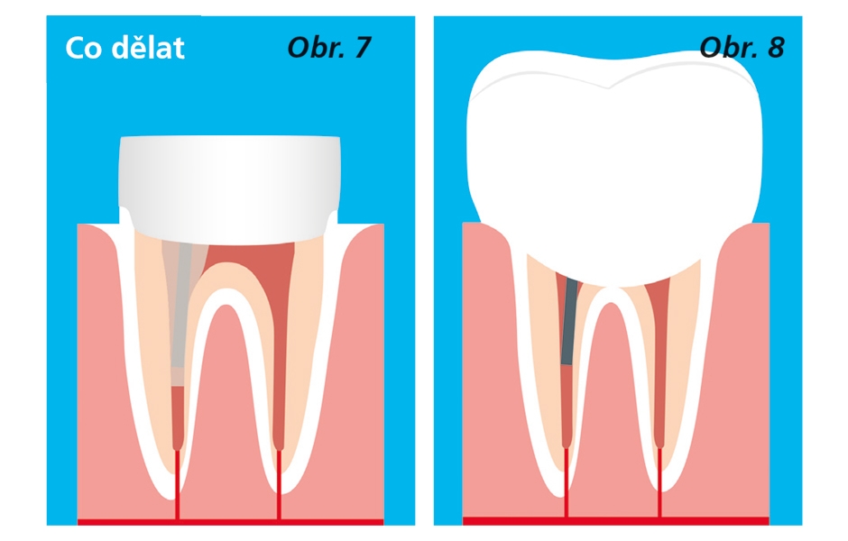 Obr. 7: Použít kompozit typu bulk-fill ke zhotovení dostavby. Obr. 8: Umístit definitivní náhradu.