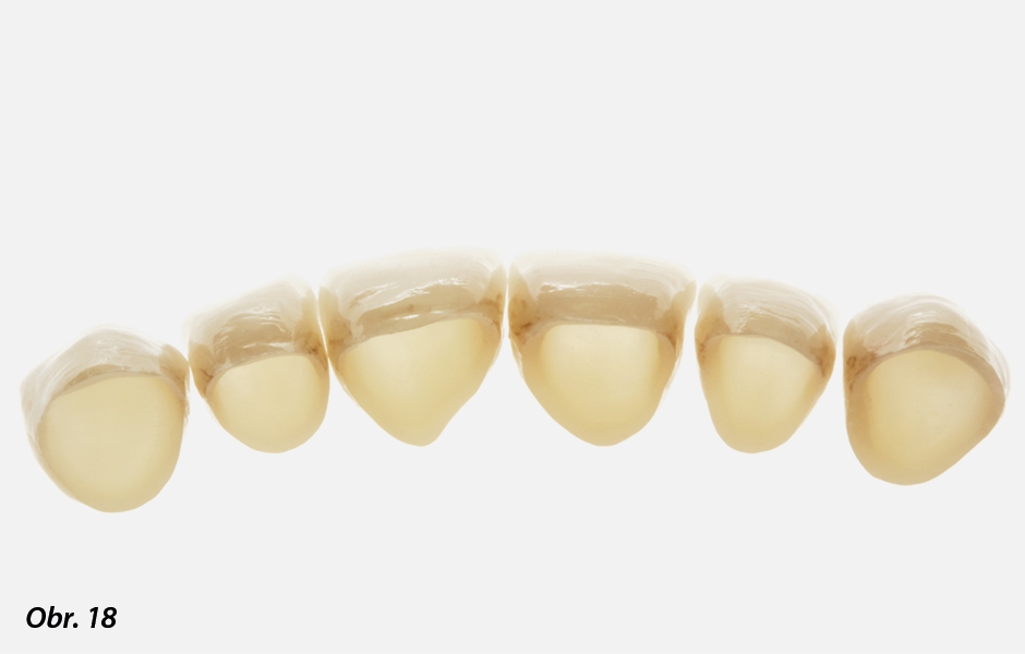 Přirozeně vypadající translucence materiálu Zolid FX umožňuje upustit od vrstvení dentinového materiálu fazetovací keramiky.