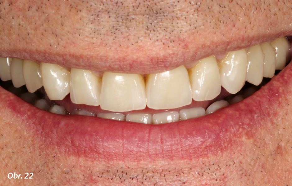Nové zuby s mírně abradovanými fazetami a prasklinami odpovídají pacientům s bruxismem. Cílem naší práce byla stálost, funkčnost a nenápadná integrace náhrad.