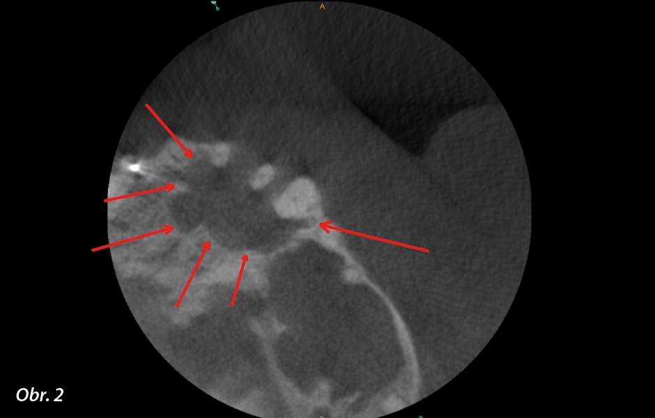 Předoperační axiální snímek na CBCT.