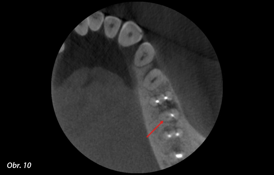 Axiální snímek na CBCT.