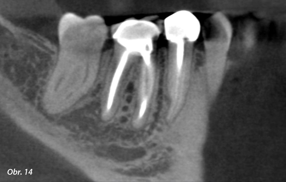 Sagitální snímek na CBCT při kontrole po 1 roce.