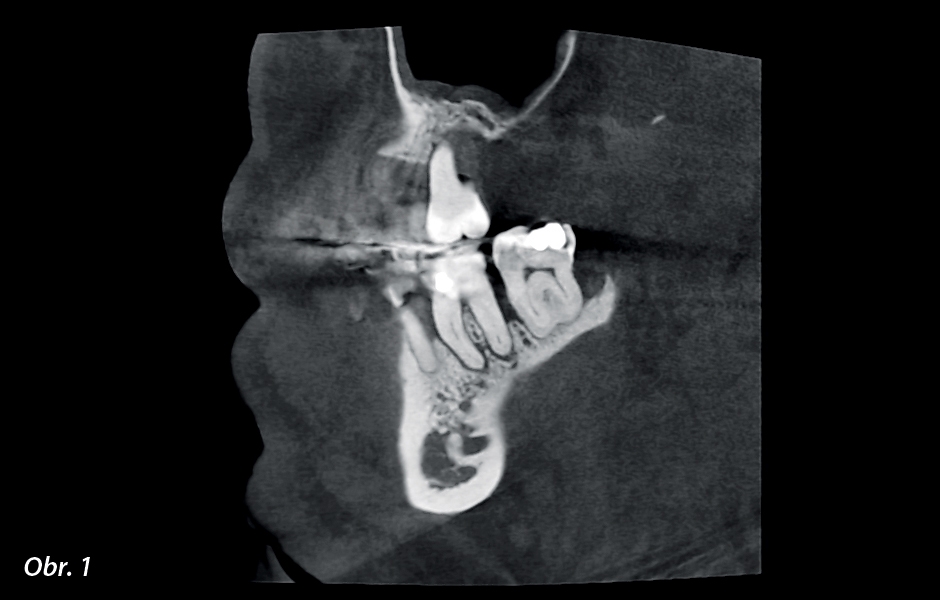 Předoperační RTG snímek zubu 37.