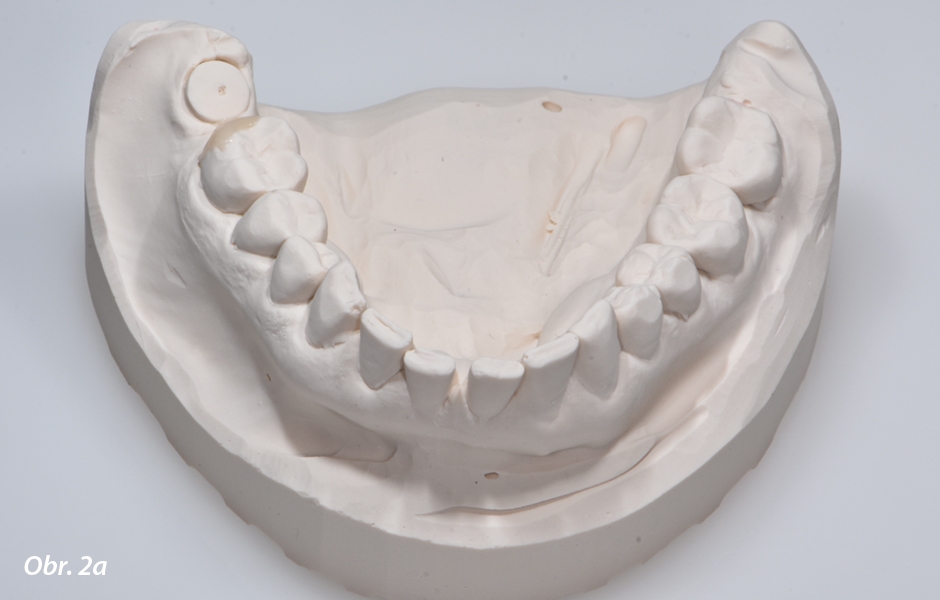 Sádrové modely. Za účelem dosažení optimálního tvaru zubu 46 jako předlohy pro provizorní náhradu, byla jeho distální část dostavěna voskem.