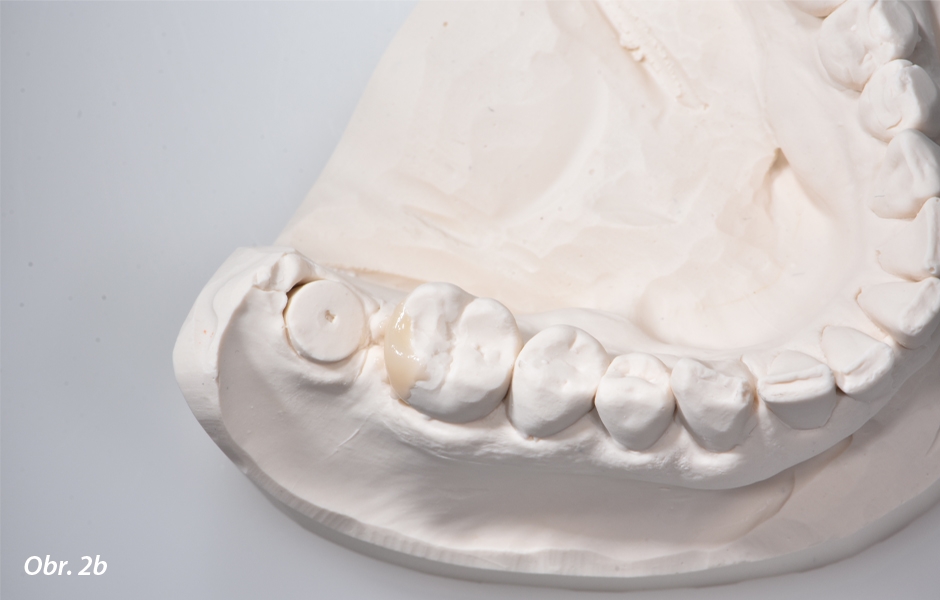 Sádrové modely. Za účelem dosažení optimálního tvaru zubu 46 jako předlohy pro provizorní náhradu, byla jeho distální část dostavěna voskem.