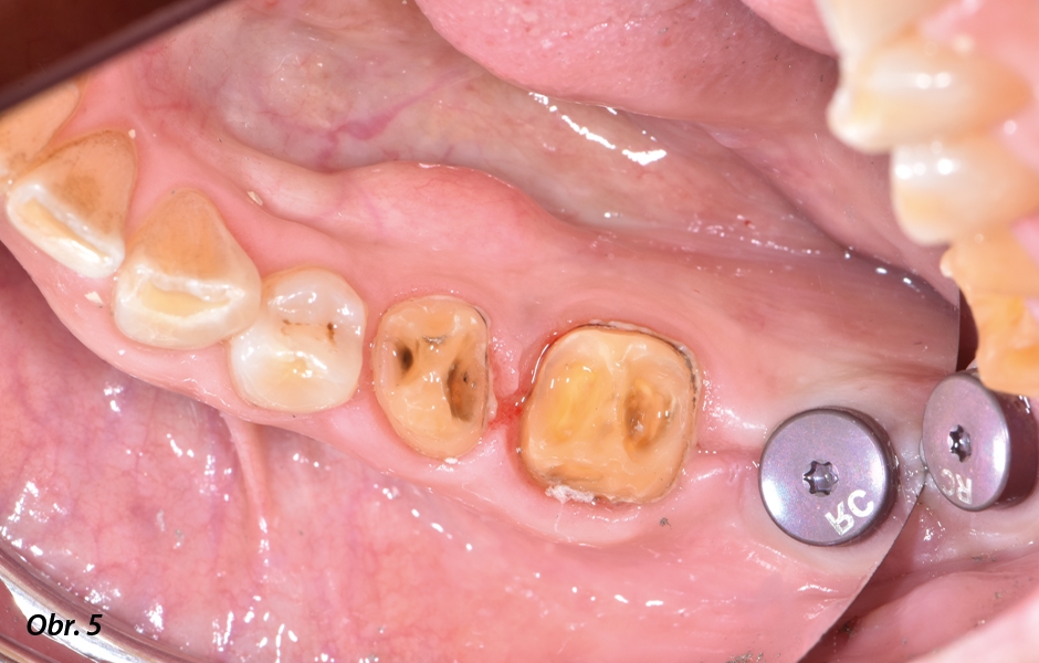  Pilířové zuby po sejmutí původních náhrad a odstranění kariézních hmot.