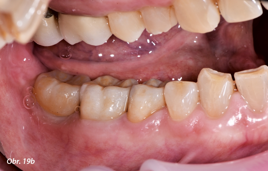 Po nacementování náhrad na zuby 45 a 46 a našroubování korunky zubu 47 na implantát.