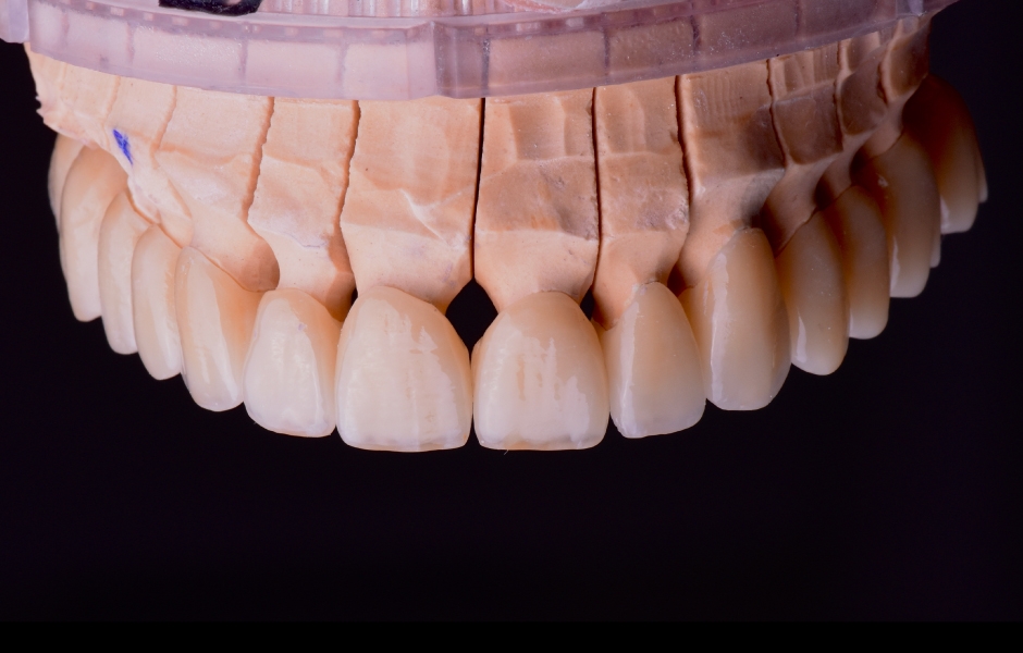 Obr. 14: Preparované zuby před fixací náhrad.