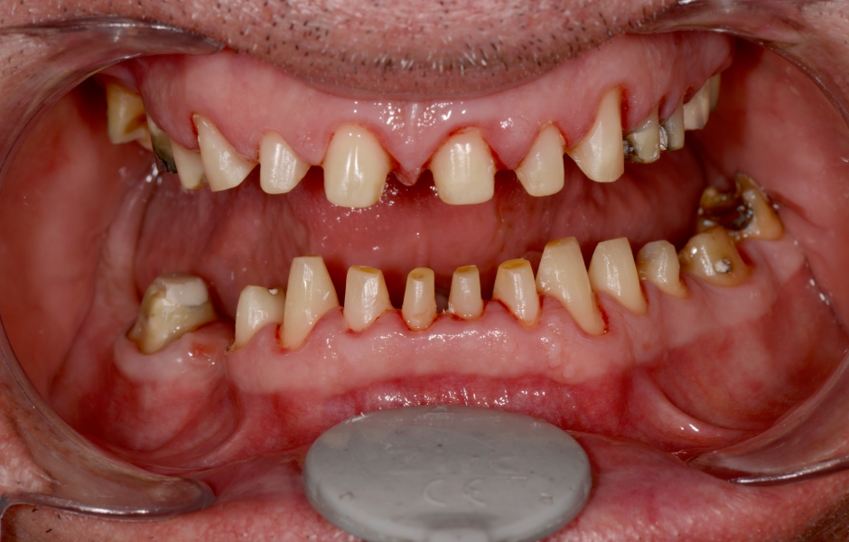 Obr. 15: Obr. 14: Preparované zuby před fixací náhrad.