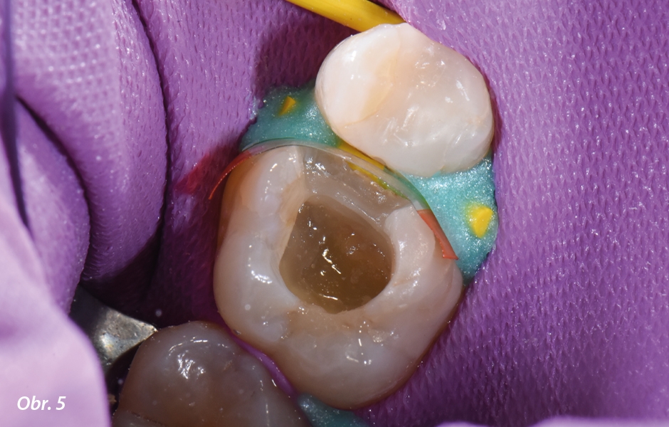 Za účelem zpevnění zbývající struktury zubu byla nejhlubší část kavity vyplněna materiálem everX Flow (odstín Bulk).