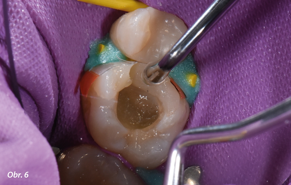Pro zajištění těsného bodu kontaktu byla páska matrice během polymerace podržena u sousedního zubu nástrojem na nanášení kompozitu.