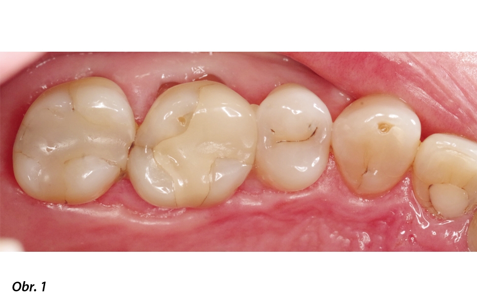 Počáteční situace: rozsáhlá kariézní léze na distální plošce zubu 16, který byl již před 16 lety ošetřen rozsáhlou onlejí.
