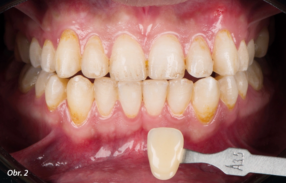 Počáteční odstín zubů před bělením byl A3.5. Fotografie situace před ošetřením je velice důležitá pro určení správného odstínu a vyhodnocování pokroku při bělení – počáteční odstín byl dle klasického vzorníku VITA A3.5.