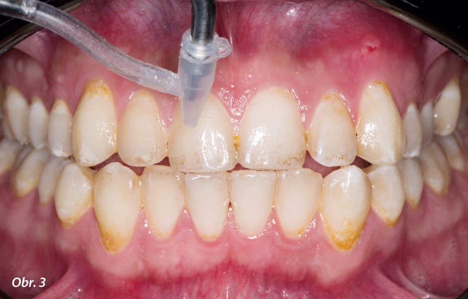 Opískováním zubů se odstraní skvrny minimálně invazivně. Opískováním práškem na bázi uhličitanu sodného za použití přístroje AquaCare se odstraní všechny skvrny z povrchu skloviny.