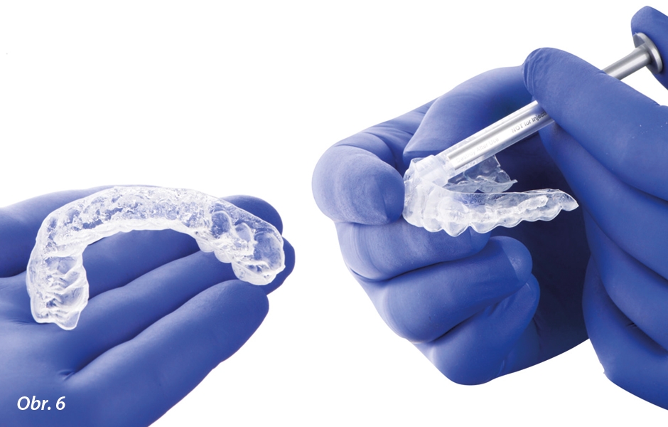 Nanášení bělicího gelu do nosičů. Pacient by měl dostat jednu až dvě stříkačky gelu, aby mohl bělení provádět po dobu jednoho týdne. Pacient by měl být instruován, aby hlásil veškeré neobvyklé změny u zubů a dásní.