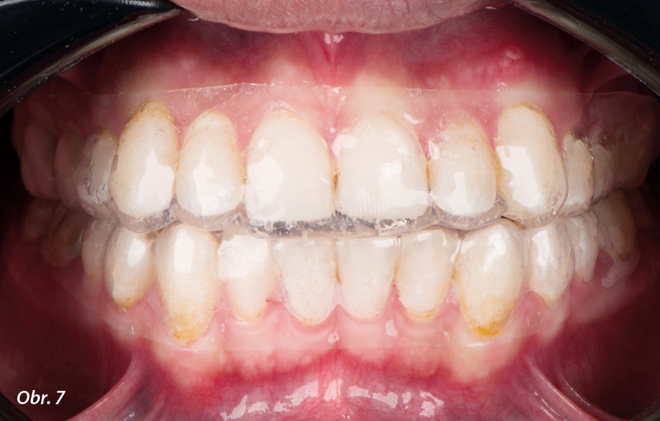 Nasazení nosičů pro bělení do úst. Po zkontrolování přesnosti, adaptace k tkáním a držení individuálně zhotovených nosičů je pacient instruován, jak má nosiče nasazovat a jak nanášet gel s 16% karbamid peroxidem (jedna kapka na každý zub).