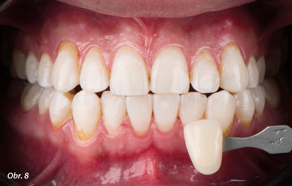 Kontrola odstínu po bělení zubů. Po 14 dnech bělení 16% karbamid peroxidem (White Dental Beauty) jsme zkontrolovali dosažený odstín – výsledný odstín je dle klasického vzorníku VITA A1.