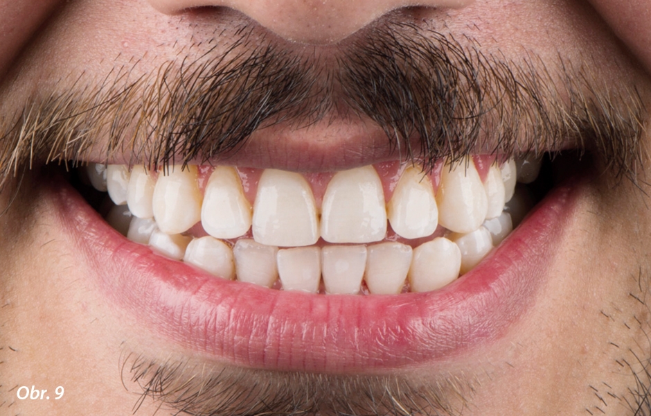Úsměv po bělení zubů. Pacient se usmívá, spokojený s výsledkem. Dostal několik tipů, jak zachovat účinky bělení delší dobu.