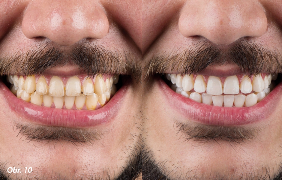 Před a po bělení zubů. Srovnání mezi úsměvem na začátku a na konci ošetření.