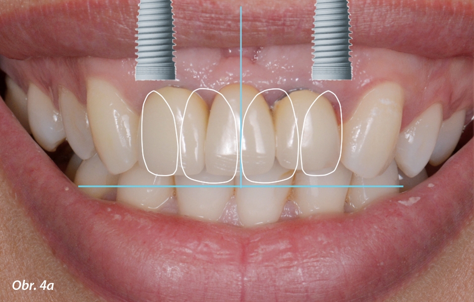 Digitální smile design (DSD) dvou možností ošetření.