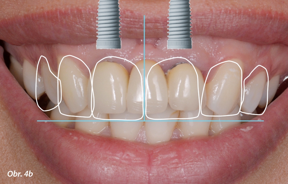 Digitální smile design (DSD) dvou možností ošetření.