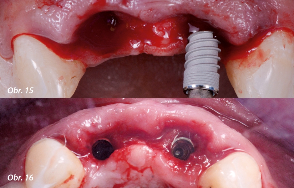 Obr. 15: Zavádění implantátu. Obr. 16: Okluzální pohled na implantáty po zavedení.