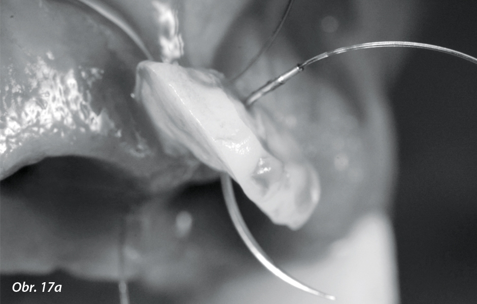 Transplantace štěpu do měkkých tkání pro zvýšení papily mezi středními řezáky.