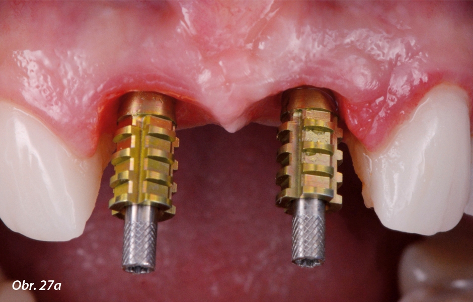 Otiskování na úrovni implantátů (technika pick-up).