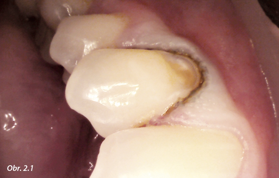 Klínovitý defekt, stav po retrakci dásně.