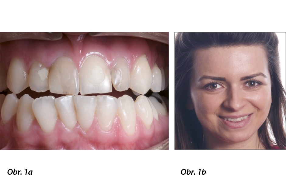 Obr. 1a: Výchozí situace: zabarvené výplně a malokluze. Obr. 1b: Pacientka Naira požádala o estetické vylepšení svého úsměvu.