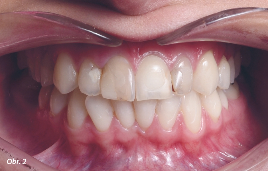 Obr. 2: Situace po ortodontické léčbě.