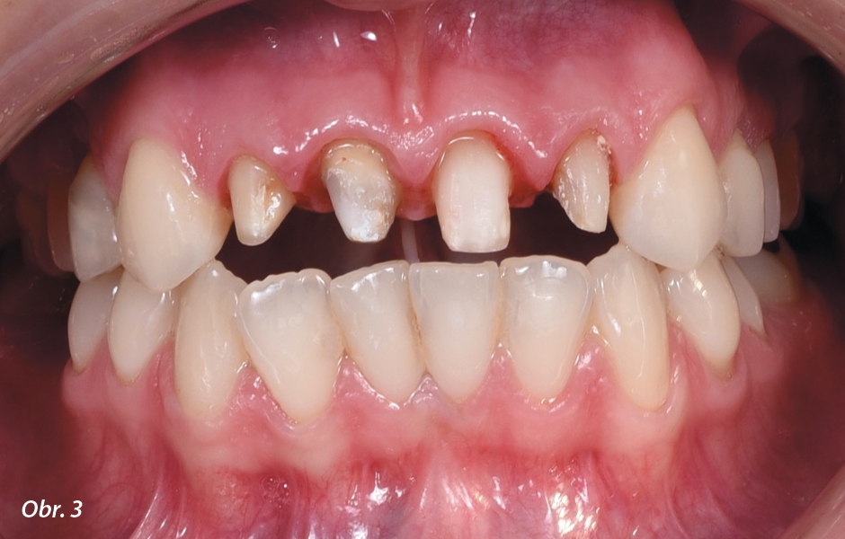 Obr. 3: Preparace korunky zubů 12 až 22.