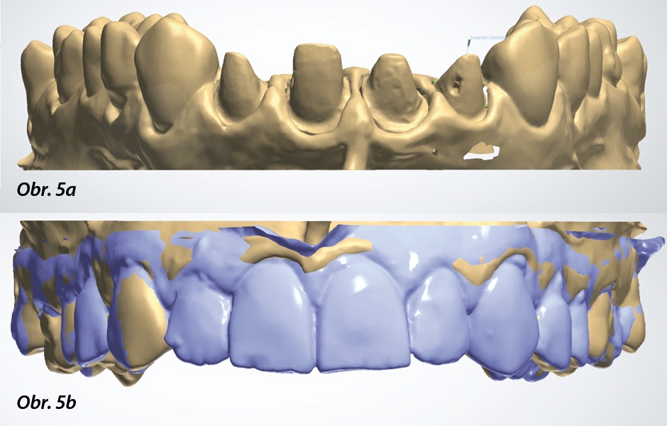 Obr. 5a, b: Digitalizovaný model preparovaných zubů v překrytí se situací před preparací.