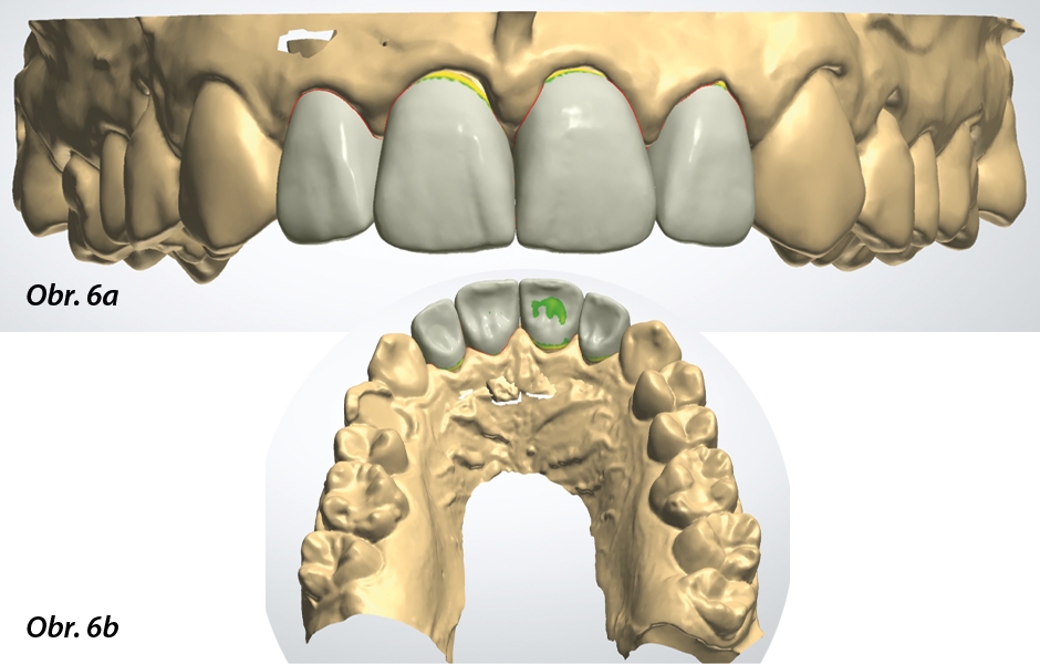Obr. 6a, b: CAD návrh plně anatomických dlouhodobě provizorních korunkových náhrad.