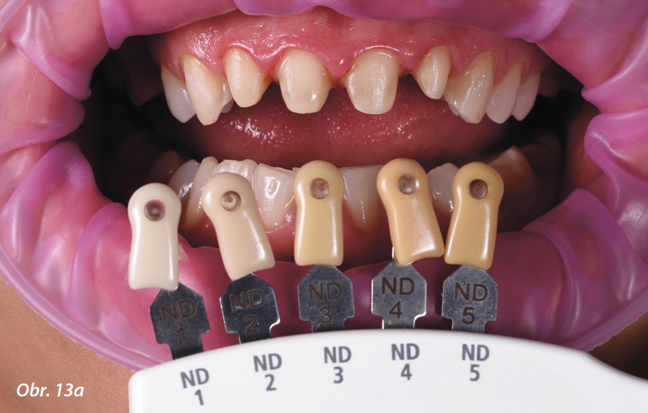 Obr. 13a: Určení odstínu preparovaných zubů v ústech pacientky. 