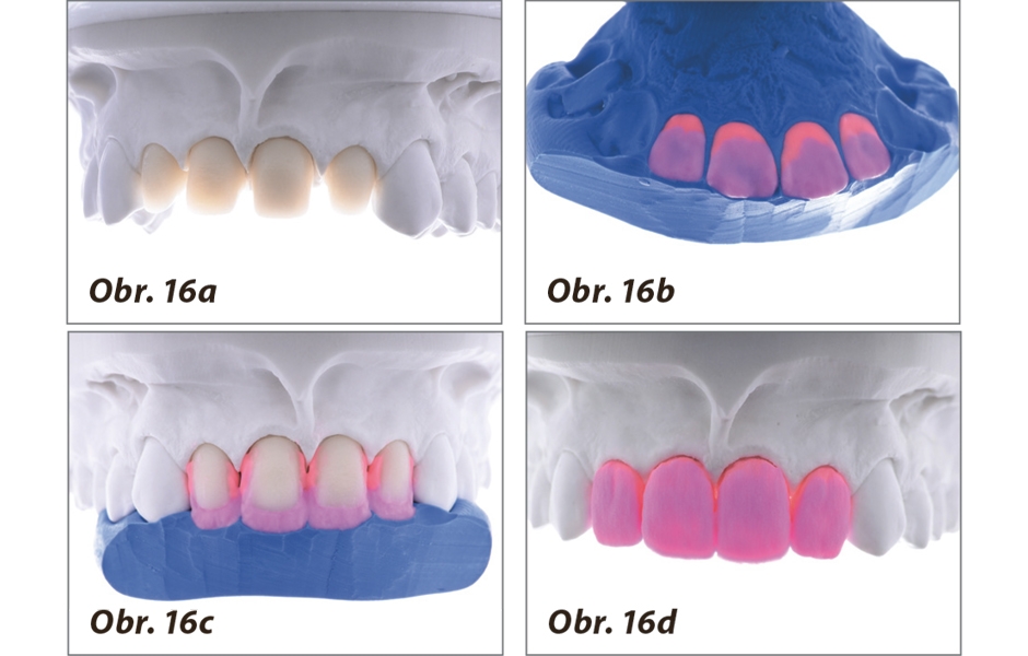 Obr. 16a–d: Vytvoření anatomického tvaru korunek pomocí dentinových materiálů.
