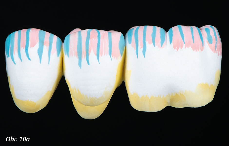 Dentin se nanáší dvakrát na aproximální a krčkové oblasti a na střední část okluzní plošky. Šedá a fialová se smíchají a nanáší na incizální třetinu a hřebeny hrbolků v rámci jednoho kroku. Nevzniká tak jednotně modrý efekt.