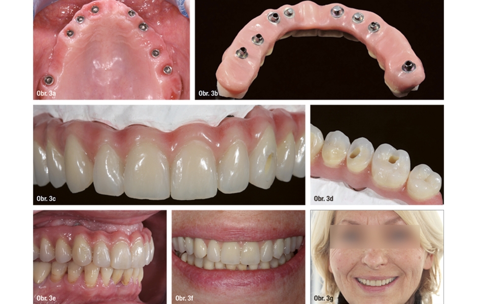 Obr. 3a–g: Fixní náhrada nesená implantáty, v tomto případě s delší dobou ošetření z estetického důvodu a funkční ošetření měkkých tkání pro umožnění kvalitní hygienické péče (náhrady zhotovil Andreas Kunz, Berlín, Německo).
