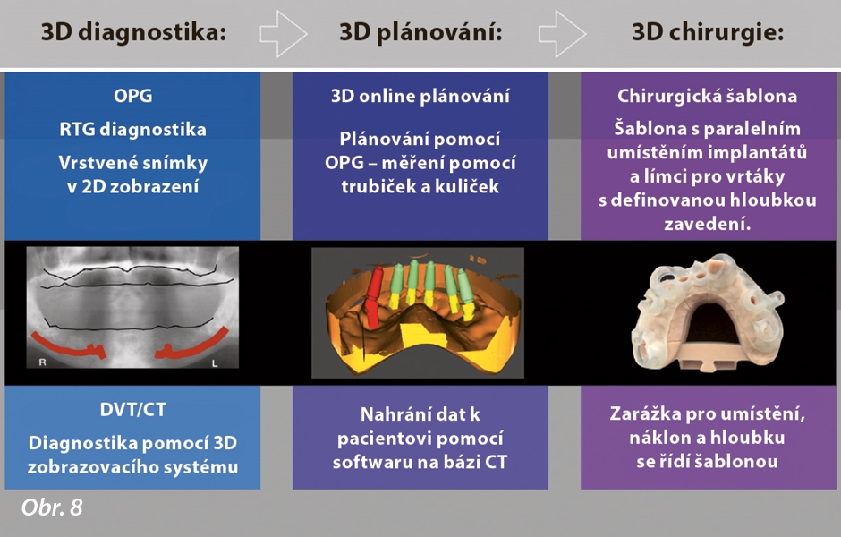 Obr. 8: Klasický postup odstupňovaného plánování implantátů na základě 2D a 3D dat, s možností přenosu těchto analytických výsledků na chirurgickou šablonu (Guided Template).