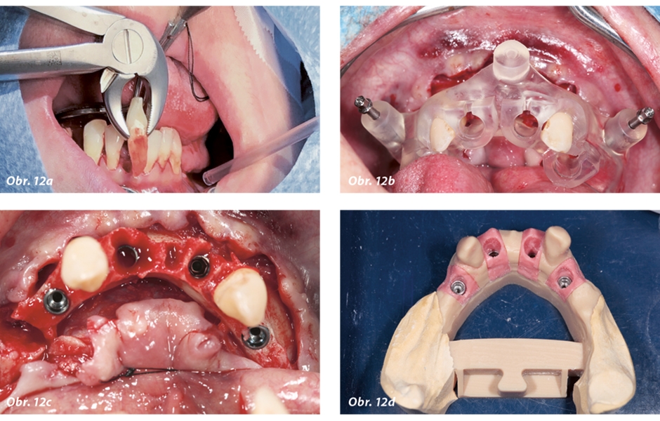 Obr. 12a–d: Kontrola a výsledek zákroku s R2Gate provedeného na základě plánování. Logická posloupnost všech jednotlivých kroků: a) extrakce; b) nasazení šablony R2Gate; c) výsledek: zavedené implantáty; d) model situace.