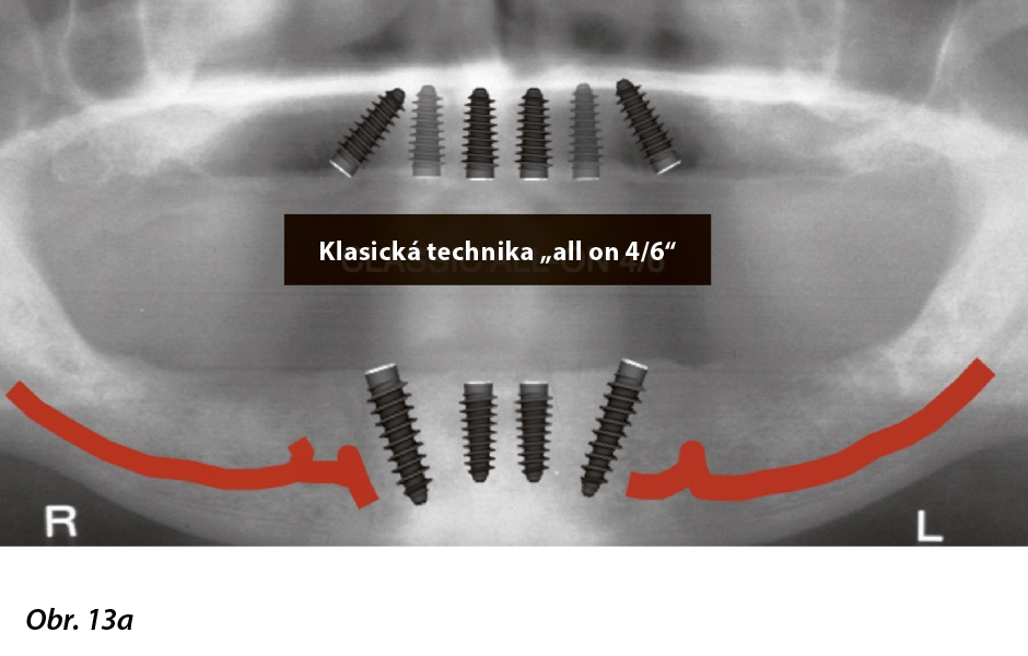 Obr. 13a, b: Koncepce „all on X“: a) šikmé umístění distálních implantátových abutmentů; b) modifikované paralelní uspořádání všech implantátových abutmentů.