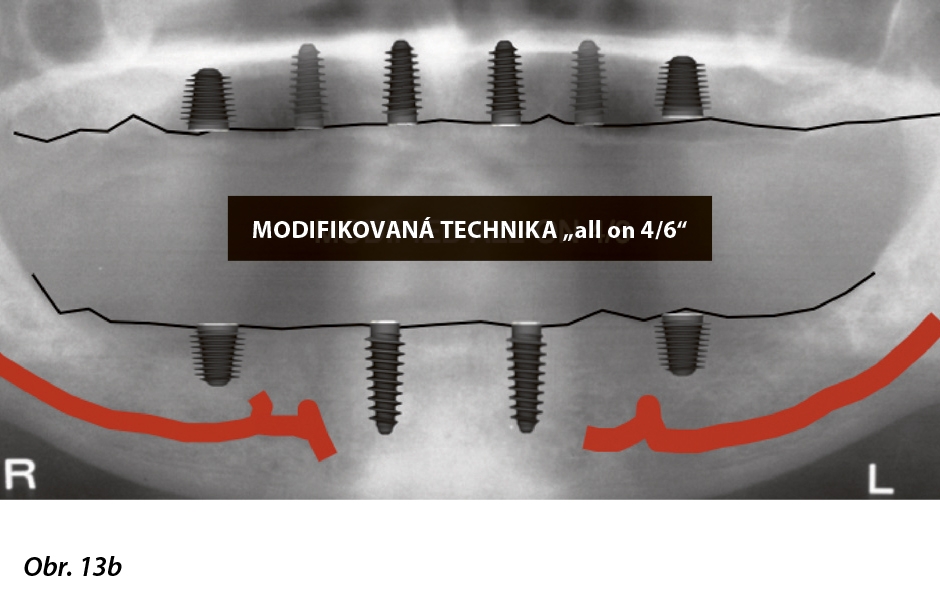 Obr. 13a, b: Koncepce „all on X“: a) šikmé umístění distálních implantátových abutmentů; b) modifikované paralelní uspořádání všech implantátových abutmentů.